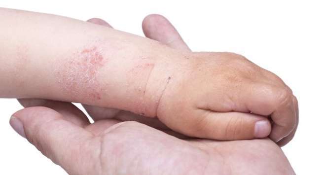 Eczema challenges for pediatric patients, there is hope!